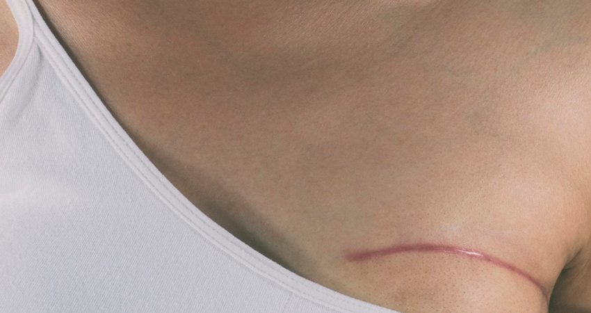 Sancionada Lei que garante atendimento fisioterapêutico a mastectomizadas