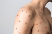 Piauí investiga primeiro caso suspeito de monkeypox ou “varíola do macaco” 