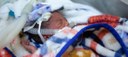152 milhões de bebês nasceram prematuros na última década