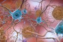 Alzheimer: em testes, nova droga reduz a progressão da doença em 35%