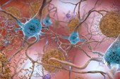 Alzheimer: em testes, nova droga reduz a progressão da doença em 35%