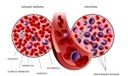 Autorizada pesquisa em pacientes com leucemia linfoide aguda B