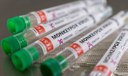 Brasil recebe 1° lote de vacinas contra a Monkeypox