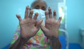 Janeiro Roxo luta contra preconceito referente à hanseníase