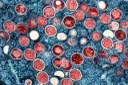 Mpox ou varíola M é emergência de saúde pública de preocupação internacional Mpox ou varíola M é emergência de saúde pública de preocupação internacional