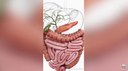 Oncologista alerta sobre o câncer de pâncreas: a ameaça silenciosa que exige atenção