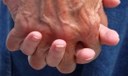 Problemas intestinais: maior risco de doença de Parkinson