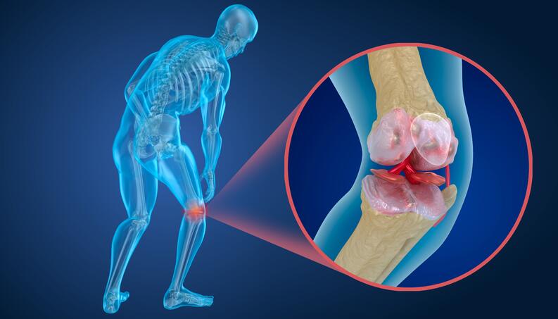Saiba como a osteoporose afeta a vida de milhões no Brasil