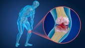 Saiba como a osteoporose afeta a vida de milhões no Brasil
