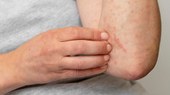 Pacientes com dermatite atópica passam a contar com tratamento integral no SUS