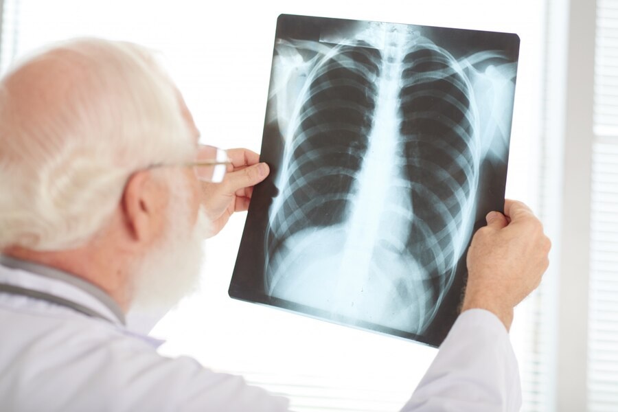 Pesquisa estima que Brasil não alcançará metas da OMS para controle da tuberculose até 2030