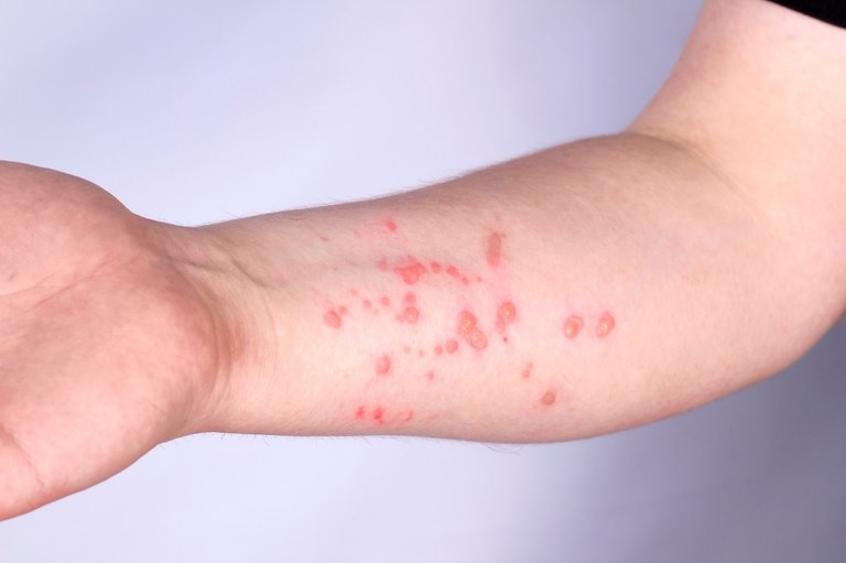 Pesquisadores da Fiocruz avançam no estudo do vírus mpox