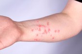 Pesquisadores da Fiocruz avançam no estudo do vírus mpox
